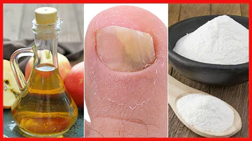 ¿Qué cantidad de vinagre utilizar para los hongos en las uñas de los pies?