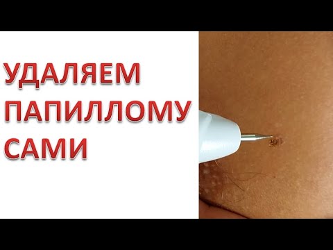Как пользоваться электро коагулятором чтобы удалить папиллому, гемангиому или родинки самому.