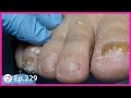 Ep.229 - Old Lady and Her Rust Fungus Toenails Got Fixed