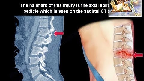 Flexion Distraction Injury Of The lumbar  Spine - Everything You Need To Know - Dr. Nabil Ebraheim