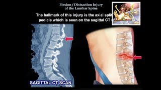 Flexion Distraction Injury Of The lumbar  Spine - Everything You Need To Know - Dr. Nabil Ebraheim