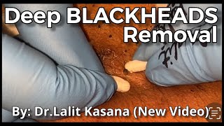 Deep Old Blackhead Removal with Cotton Buds & Extractor by Dr.Lalit Kasana