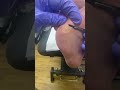 Watch a podiatrist remove corn and calluses with ergonx and docpods for healthy and painfree feet