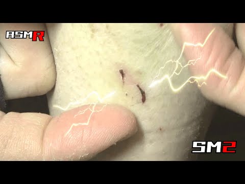 【スッキリ！アトピー性皮膚炎ASMR】超痒い脛を爪で掻く音/癒し/リラックス効果/睡眠導入/マッサージ