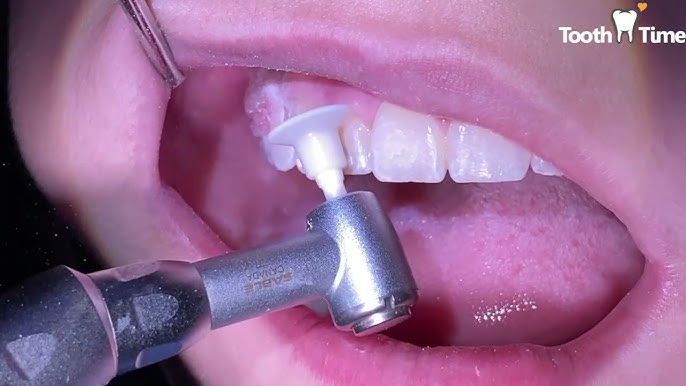 Braces on - How to put in rubber bands at home - Tooth Time Family  Dentistry New Braunfels 