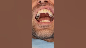 Treating darkened teeth with IVENEER