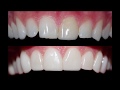 Dental procedures of placing dental veneers at cosmetic dental associates