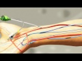 Radial Artery Puncture Using The Insyte And Angiocath Technique Radial Artery Puncture Using The Insyte And Angiocath Technique