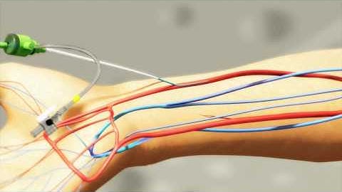 Radial artery puncture using the 