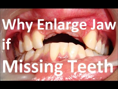 Why Enlarge The Jaws, When Some Teeth Are Missing by Prof John Mew
