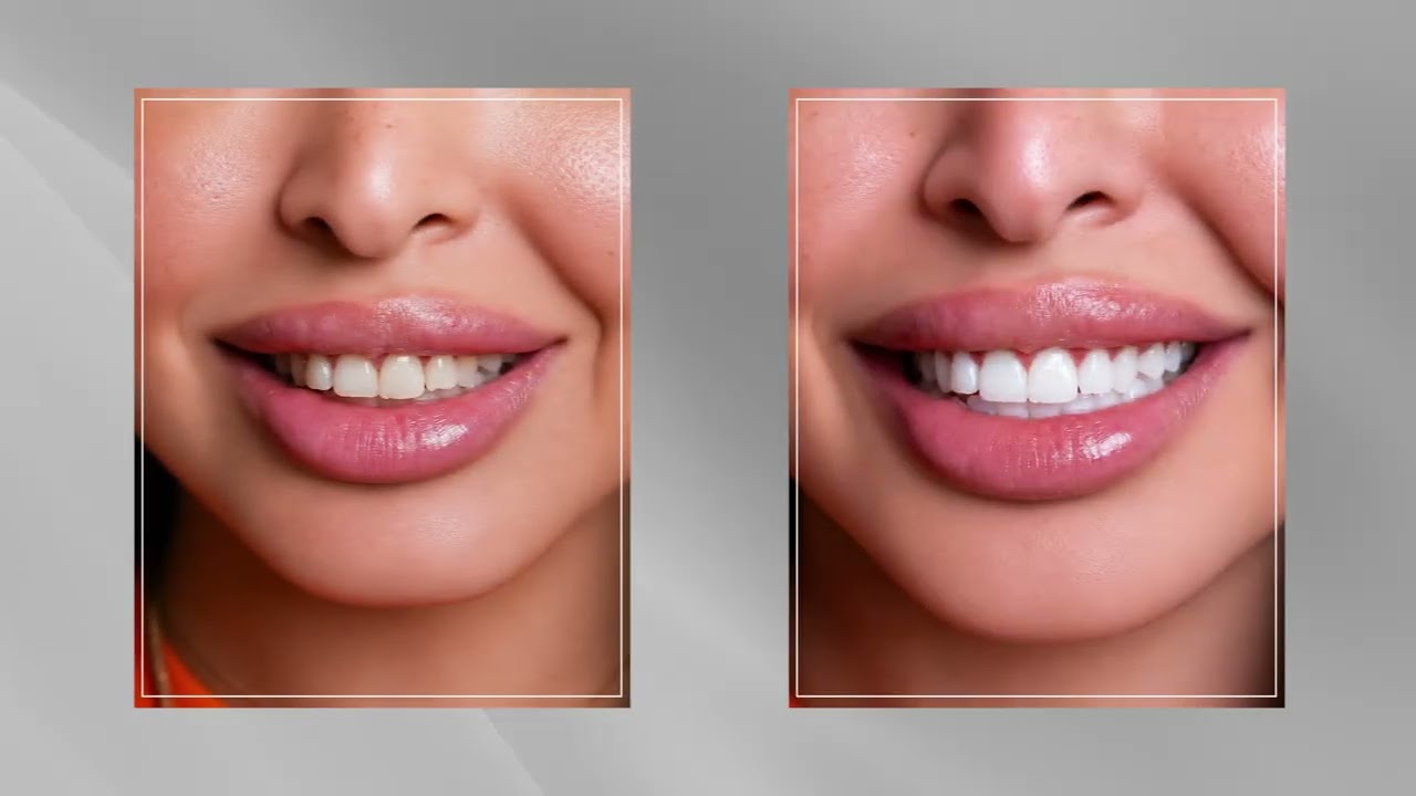 Teeth Whitening, Scaling & Polishing | Get a Brighter, Healthier Smile
