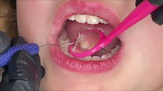 Still using the explorer to “stick” into caries? by Hygiene Edge 2,118 views 3 months ago 44 seconds