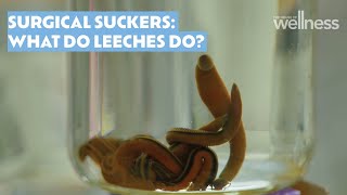 Surgical suckers: Exploring the role of leeches in modern medicine