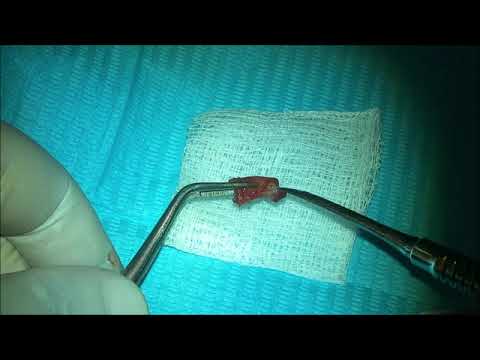 Immediate Implant Placement and Ridge Augmentation using L PRF