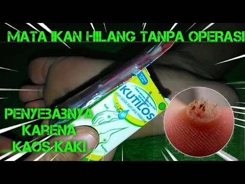 Cara Ampuh Menghilangkan Mata Ikan, Kutil, dan Kapalan