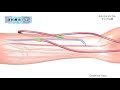 血液浄化療法（透析）／ミルメディカル 家庭の医学 動画版