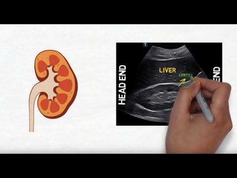 Image of Hydronephrosis on kidney ultrasound