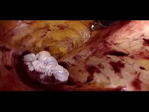 Endoscopic Ant Comp Separation in Lap V Hernia Repair