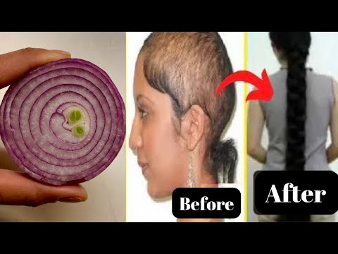 Extreme hair loss - Best Indian hair growth secret - How to use onion for hair loss?