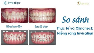 Niềng răng móm thay đổi thế nào so với kết quả clincheck 3D - KH.  Trần Hoài Linh CG1809