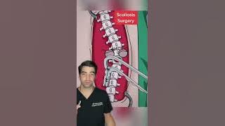 Scoliosis Surgery