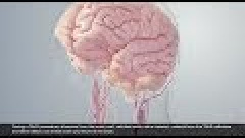 3D Animation of SENTINEL™ Cerebral Protection System