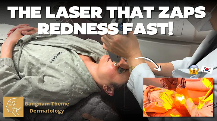 How to Get Rid of Redness & Rosacea FAST with VBeam Laser | Theme Dermatology