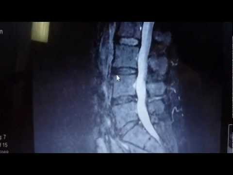 escondido-chiropractor-shows-disc-herniation-fixed-with-spinal-decompression-therapy.-mri-proves