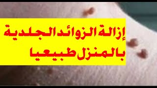 اسرع علاج منزلي طبيعي وفعال للتخلص من الزوائد الجلديه SKIN TAGS REMOVAL