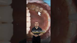 Знімаємо старі коронки☝️Андрій Марусяк #стоматологія #dentist #вініри
