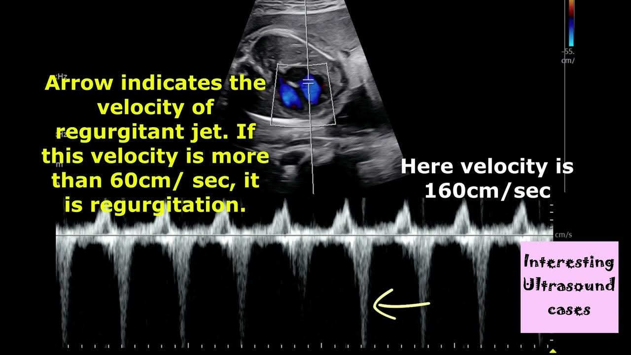 trivial-tr-tricuspid-regurgitation-in-antenatal-ultrasound-how-to