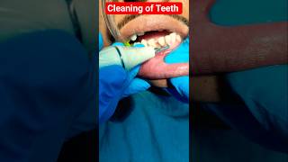 #Cleaning of Teeth by Ultrasonic Scaler #dental cleaning by Machine #stain Removal #calculus removal
