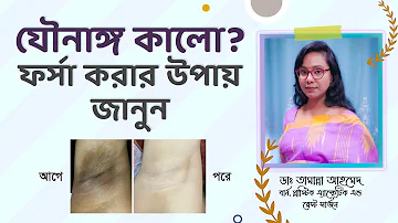 মহিলাদের যৌনাঙ্গ কালো হয় কেন এবং সুন্দর করার উপায় কী? গোপনাঙ্গের কালো দাগ। যৌনাঙ্গ কালো?