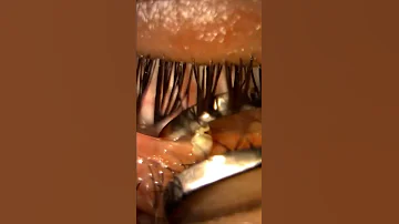Unblocking A Stye 