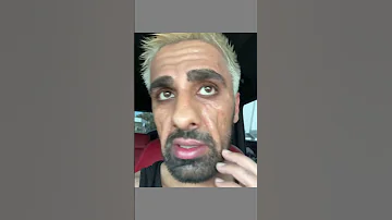 مرض مو فلوقز الخطير تشوه وجه شوفو كيف صار 