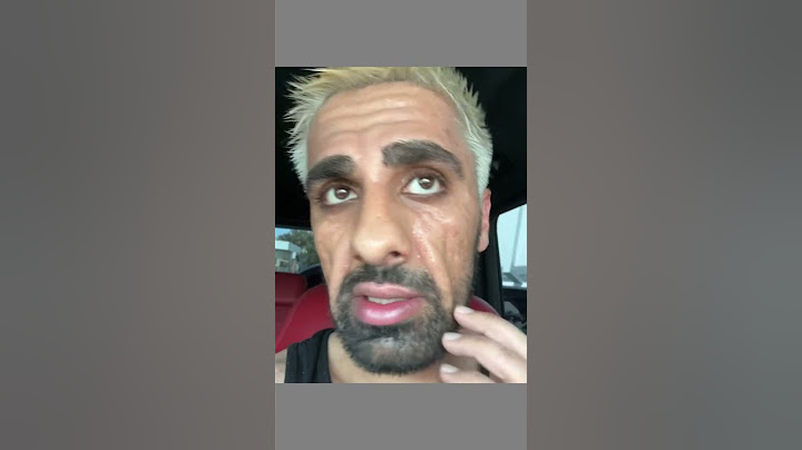 مرض مو فلوقز الخطير تشوه وجه شوفو كيف صار
