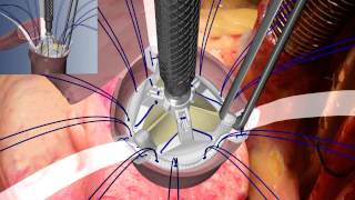 Vitality Two-step Implant Animation