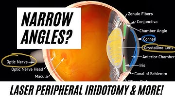 Narrow Angles? Does a Laser Peripheral Iridotomy LPI Work?