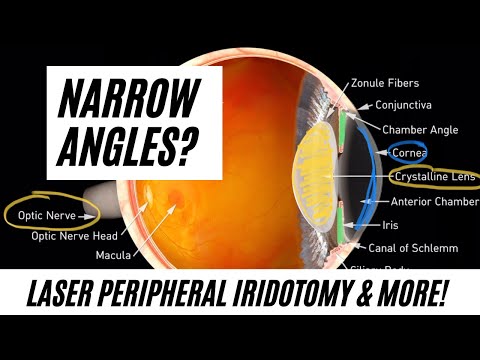 Narrow Angles? Does