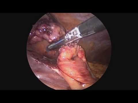 Laparoscopic Appendectomy at The Mount Sinai Hospital