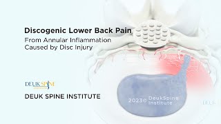 Discogenic Lower Back Pain - (3D Animation) by Deuk Spine Institute 203 views 1 month ago 36 seconds