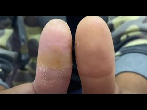 طبيب فلسطيني يعيد نمو أصابع مبتورة بدون جراحة