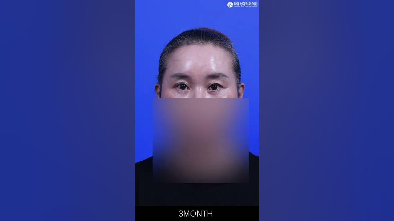 밝고 환한 눈매는 이마거상으로👀✨동안의 시작 라봄성형외과😊 - Youtube