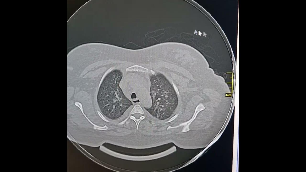Postpartum renal failure and pulmonary edema. YouTube