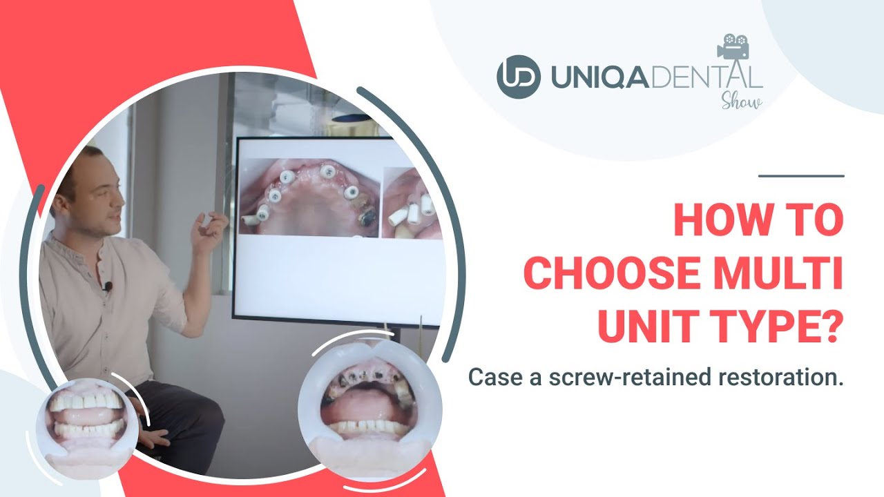 How To Choose The Correct Dental Multi units MUA Screw retained How To Choose The Correct Dental Multi units MUA Screw retained