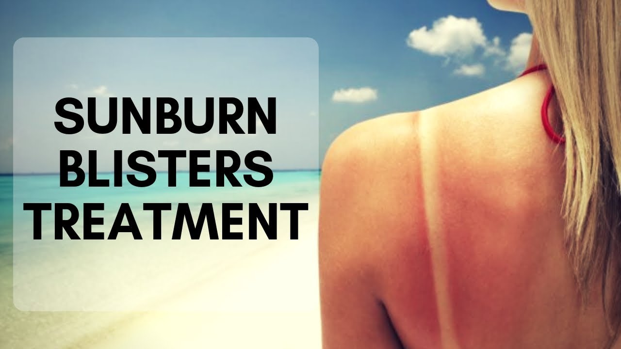 Sunburn blisters treatment on shoulders Yellow sunburn blisters