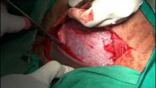 cesarean birth / C Section / LSCS/ Child Birth