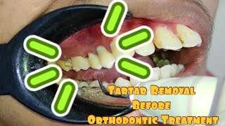 Tartar Removal Before Orthodontic Treatment @dentist_ruli