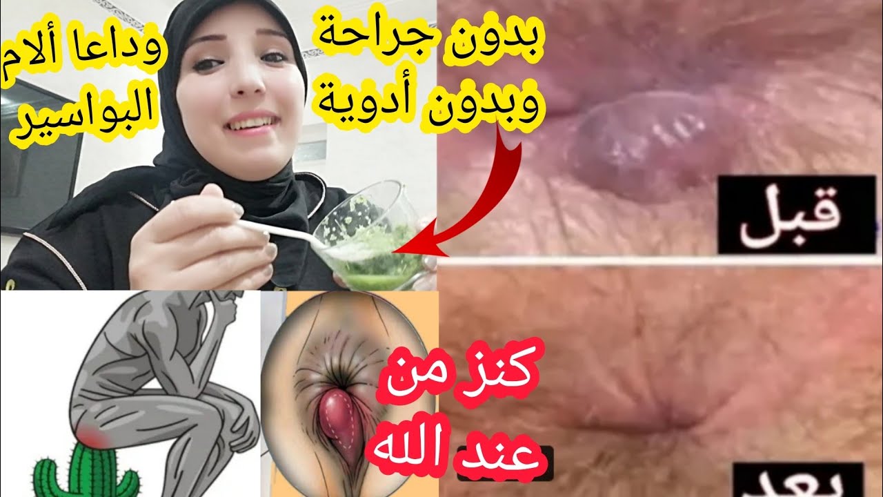 في يوم واحد علاج البواسير علاج البواسير