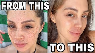 MY SKINCARE SECRETS | HOW I GOT RID OF MY FRECKLES